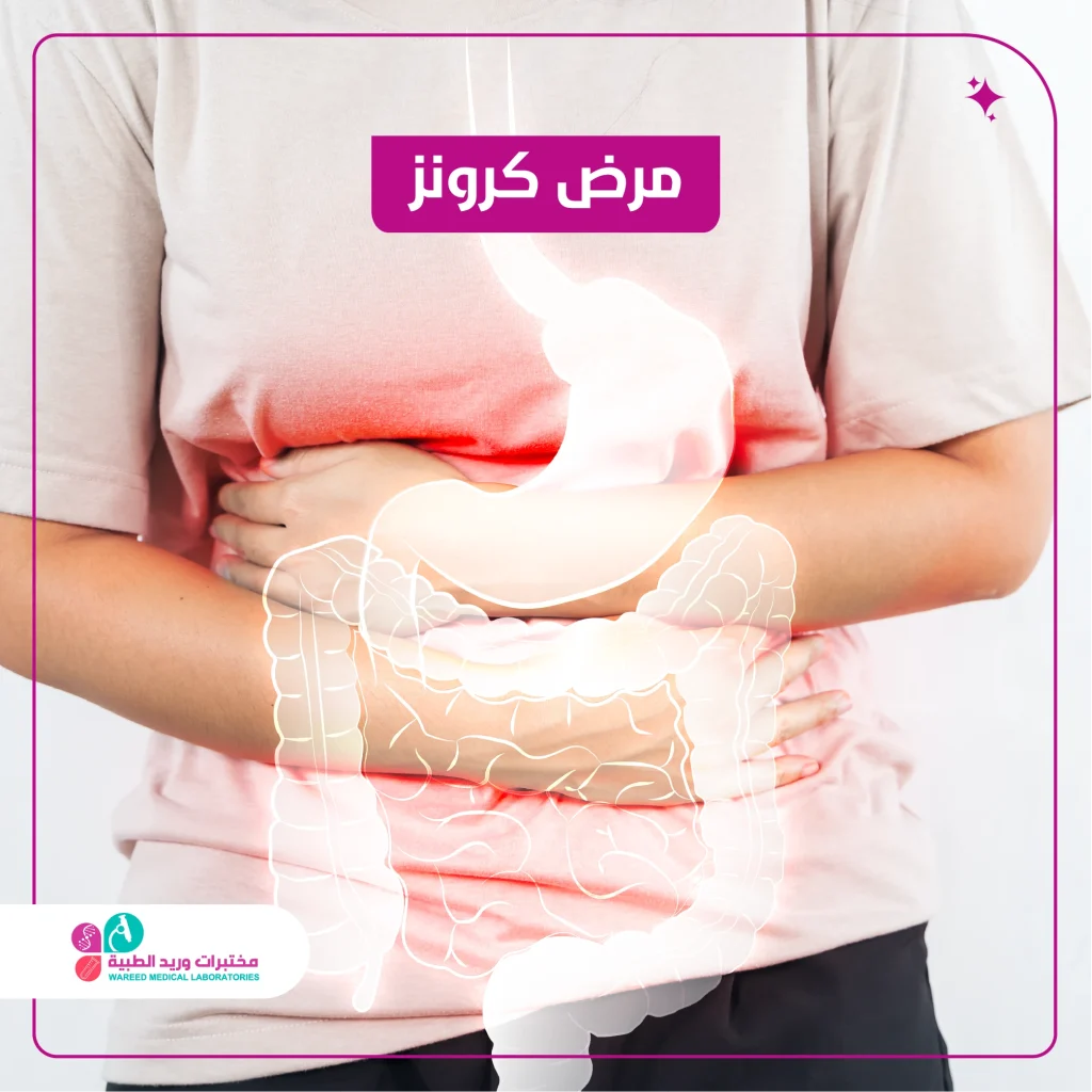 مرض كرونز