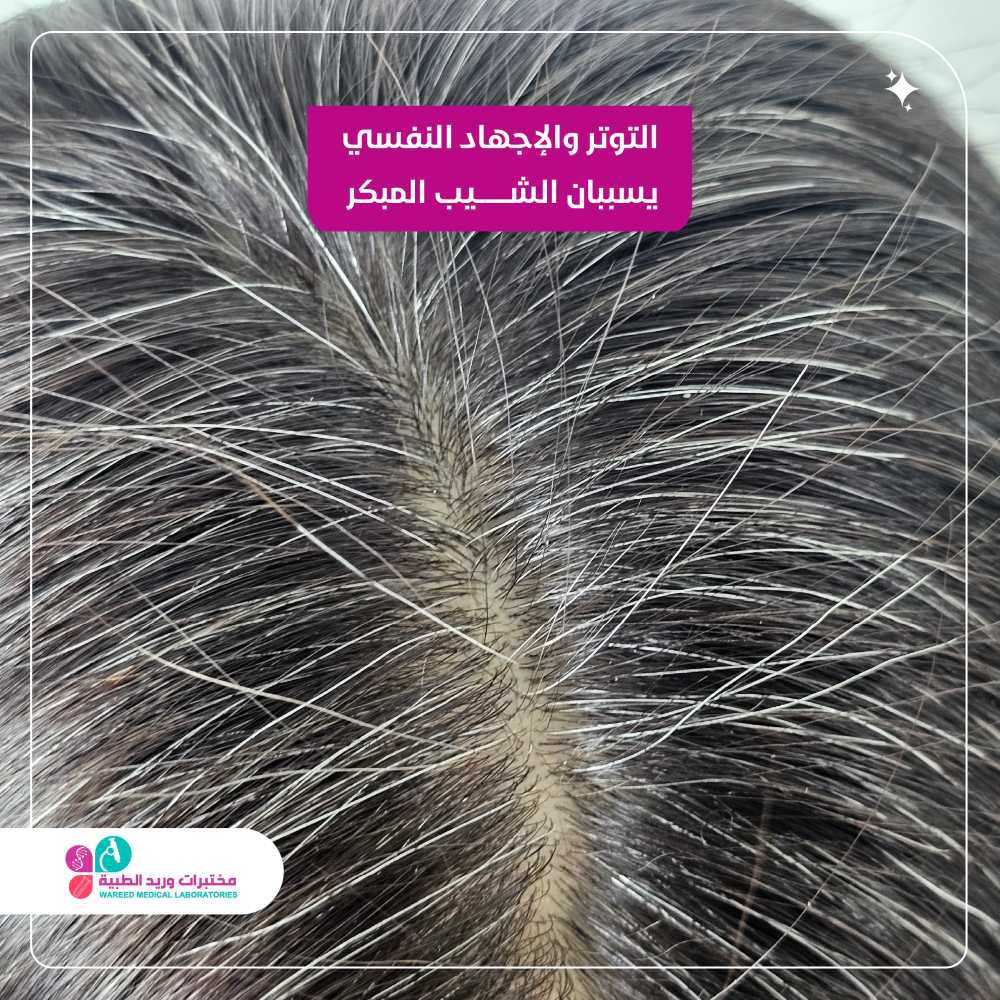 التوتر والإجهاد النفسي يسبب الشيب لاب