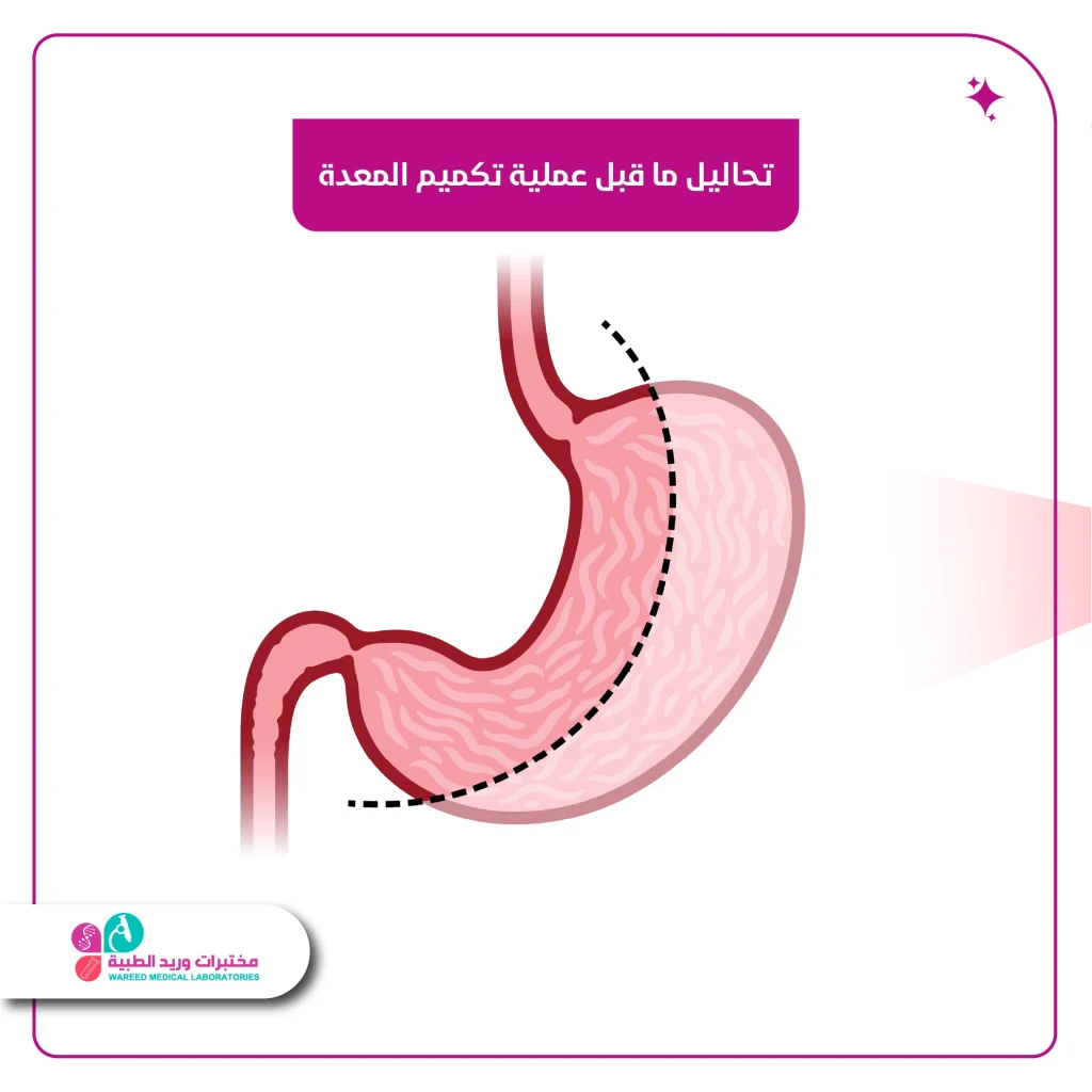 تحاليل ما قبل عملية تكميم المعدة