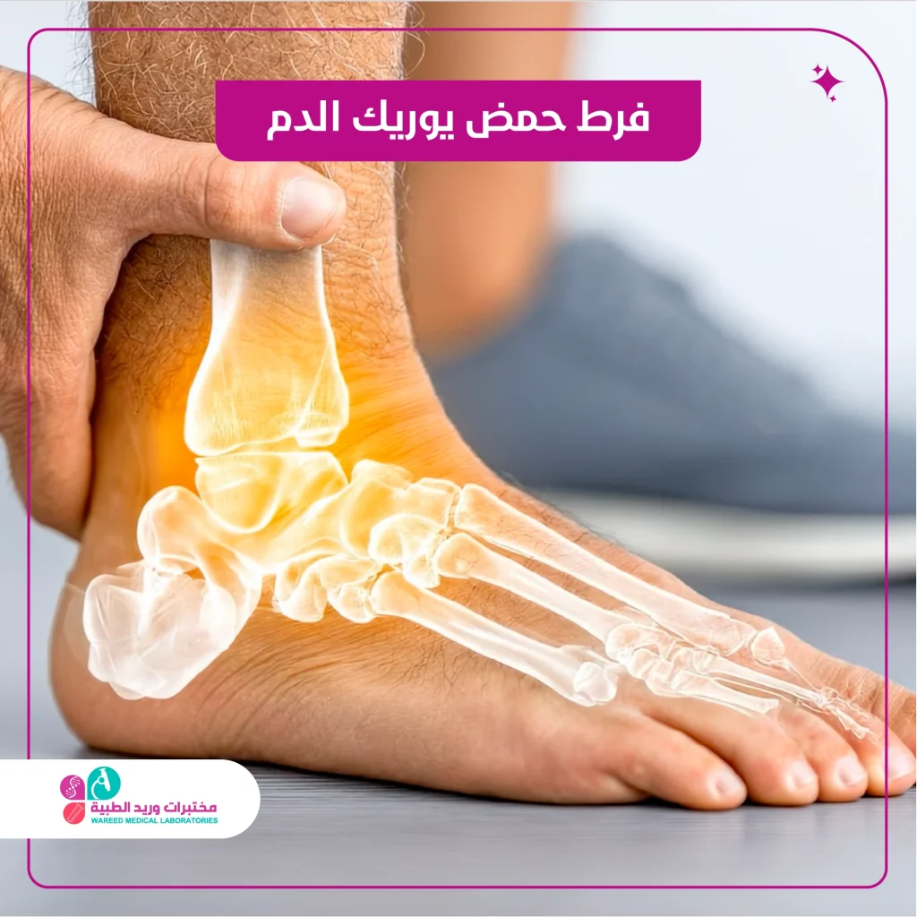 فرط حمض يوريك الدم كير